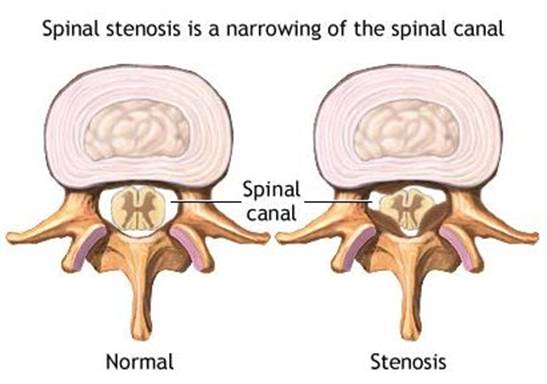 Spinal Stenosis - Spine Center of Texas