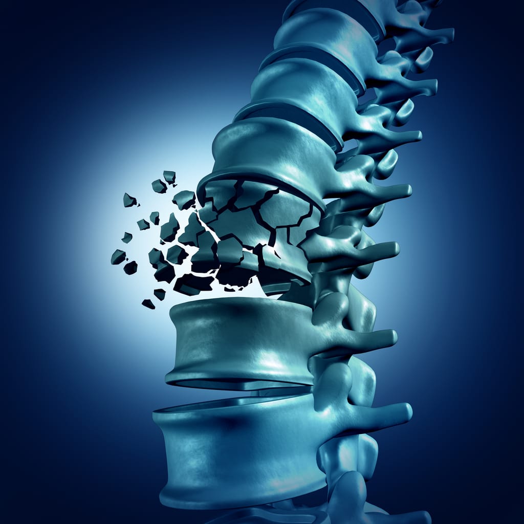 spine-fracture-1.jpg